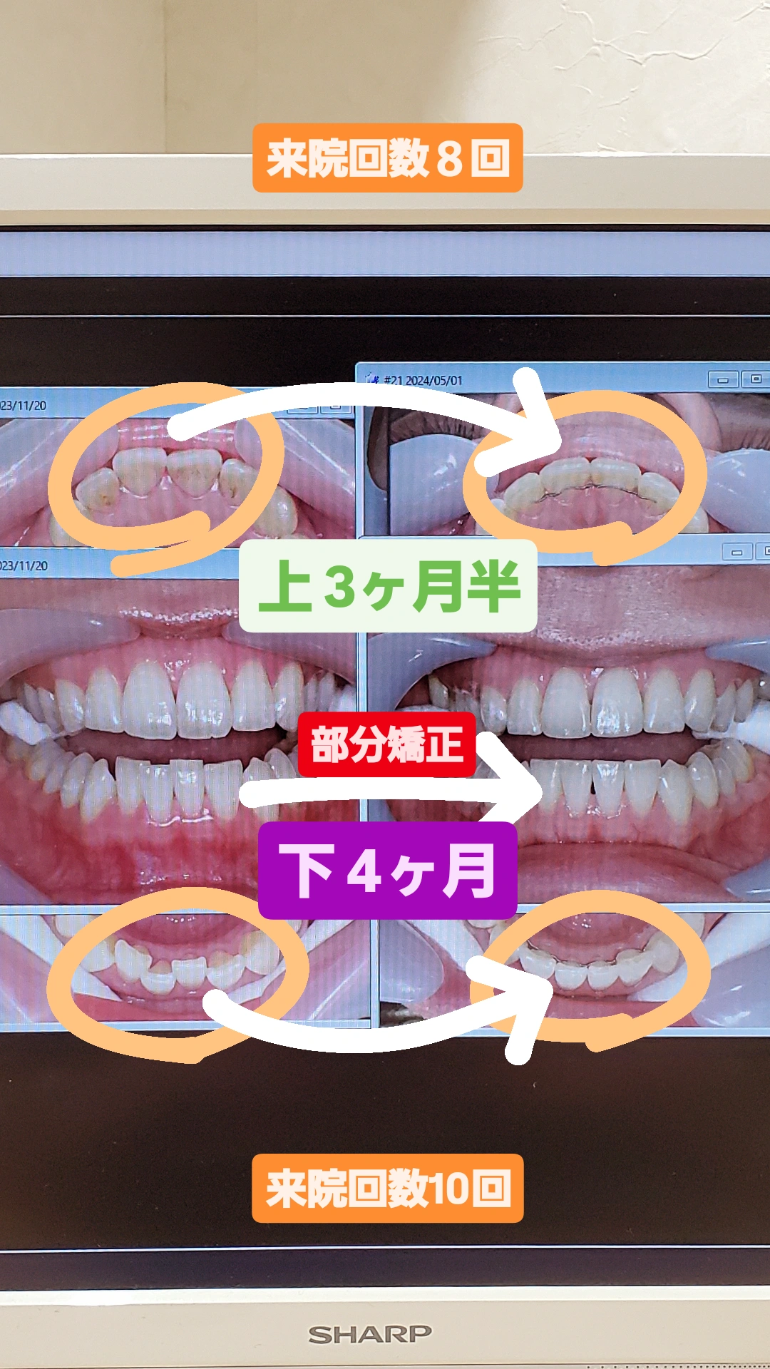出っ歯＋叢生＋非抜歯矯正