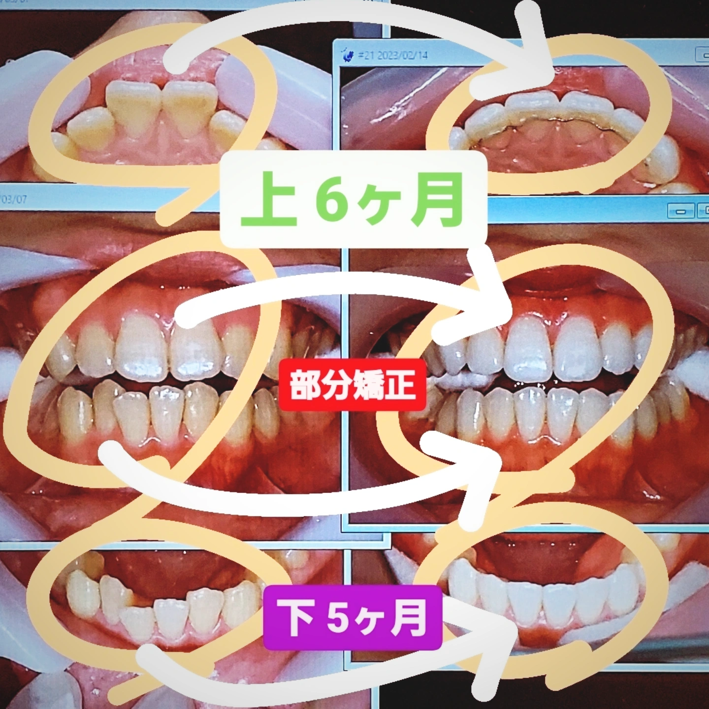 出っ歯＋叢生＋非抜歯矯正
