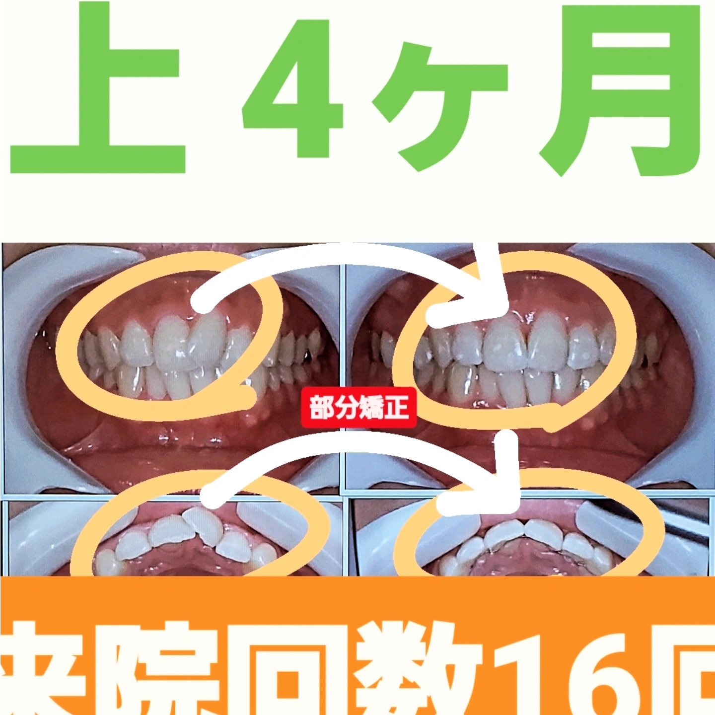 出っ歯＋叢生＋非抜歯矯正