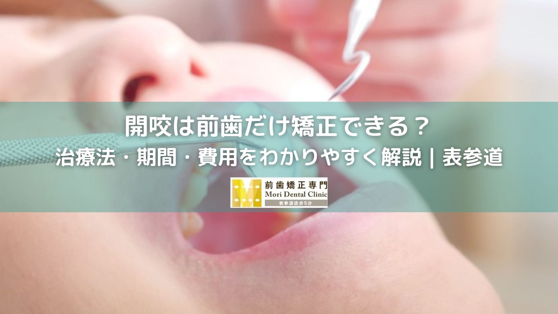 開咬は前歯だけ矯正できる？治療法・期間・費用をわかりやすく解説｜表参道